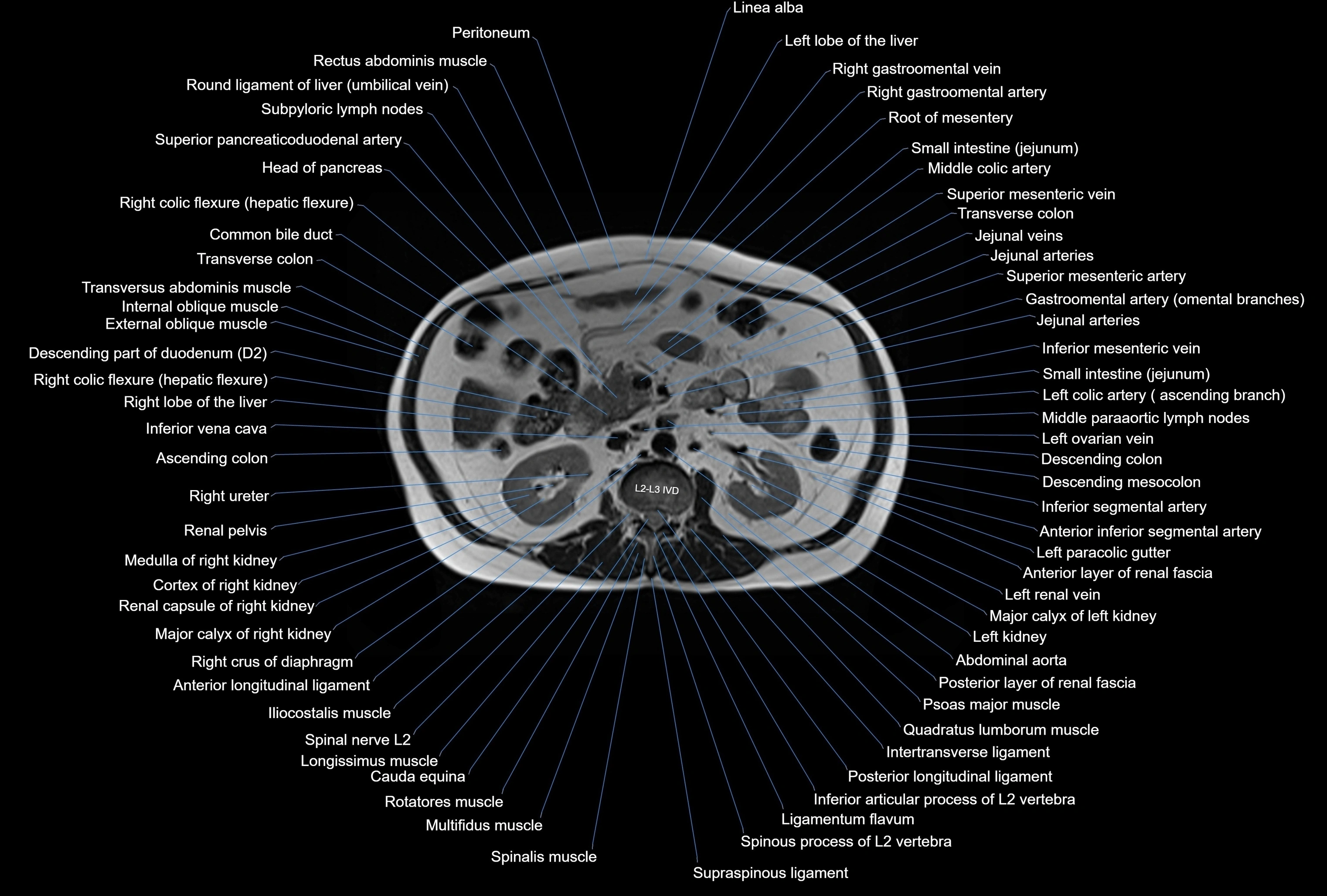 MRI Abdomen axial cross sectional anatomy radiology  image-img-00001-00022.webp